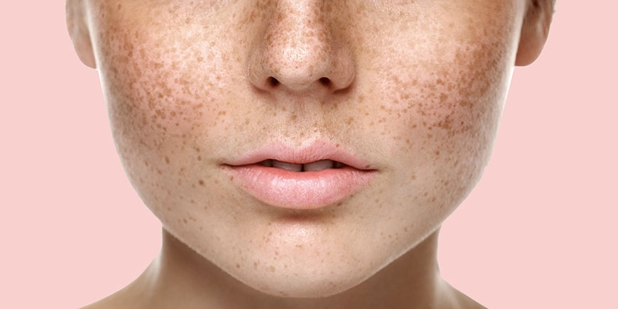 Zašto je zaštita od sunca ključna u borbi protiv tamnih mrlja